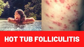 HOT TUB RASH (FOLLICULITIS) : Symptoms-Causes-Treatment-Cure-Infection-Pseudomonas Aeruginosa