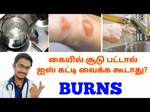 Emergency 04 || தீக்காயம் முதலுதவி || How to avoid scar ||Burns -Do&rsquo;s & Don&rsquo;ts || Dr MOHANAVEL_Tamil