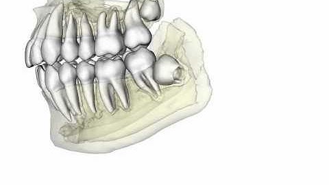 CBCT (Cone Beam Computer Tomography) - www.obteam.com - Dentist in Glendale, CA