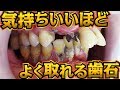 気持ちいいほどよく取れる歯石[Remove tartar]歯石除去Vol.9(牙石去除治療)