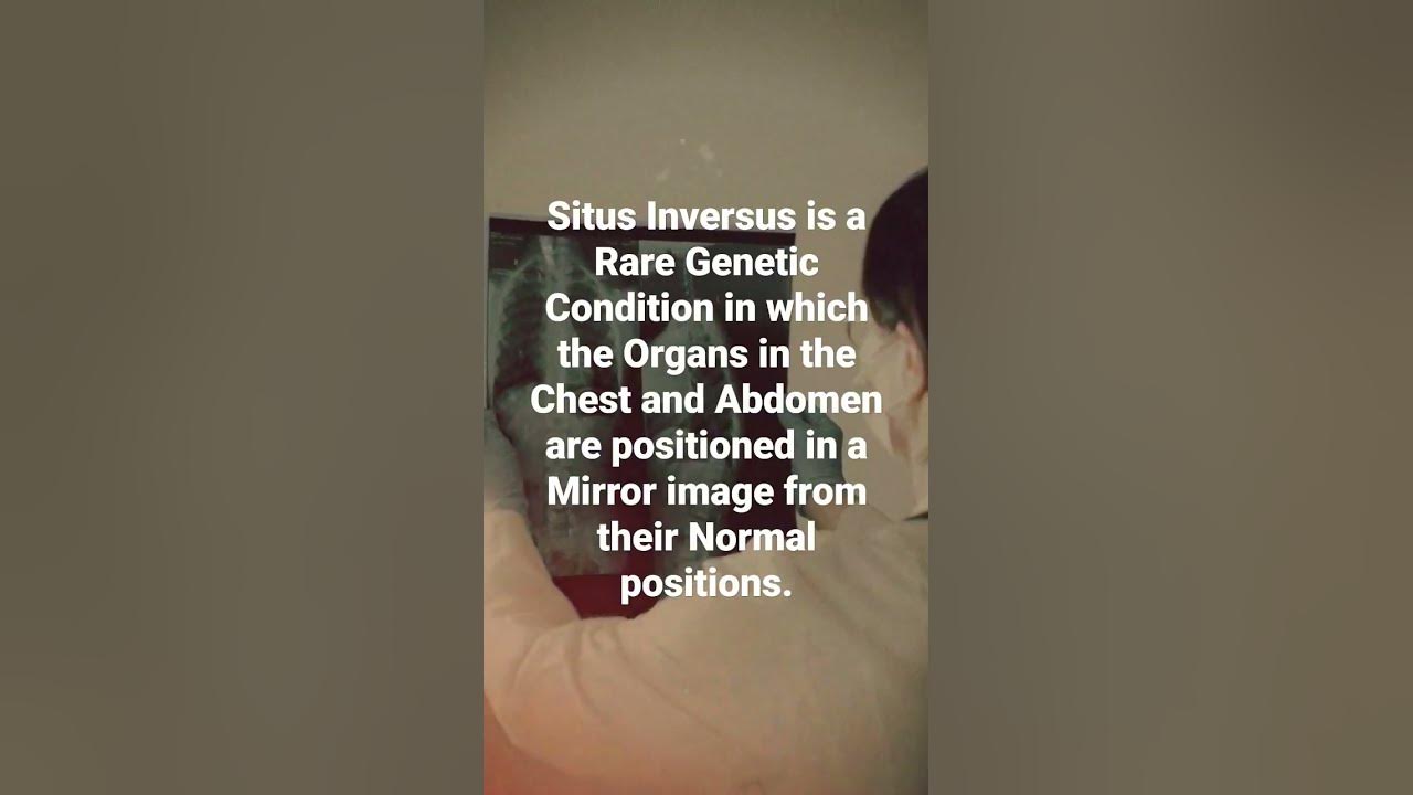 Situs inversus a rare genetic condition in which the organs are