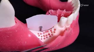 TREINAMENTO DE ENXERTO ÓSSEO MANDIBULAR COM MEMBRANA