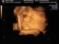 35 Week Ultrasound Liam Bane 35 Week Ultrasound Liam Bane