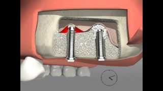 Smart Lift  Kit for Maxillary Sinus Lift with Crestal Approach