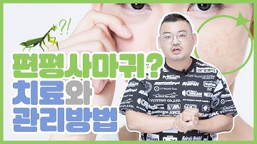 편평사마귀! 치료부터 관리방법까지 제대로 알려드림! feat. 피부과전문의