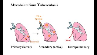 USMLE ACE Video 78: Clinical presentations and treatments for Mycobacterium Tuberculosis