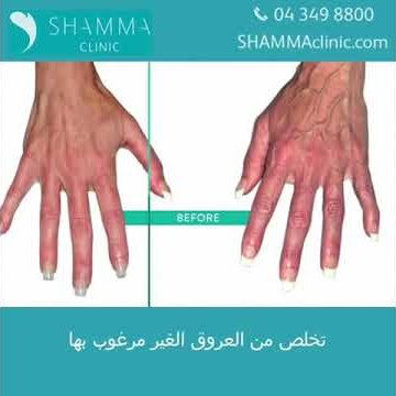Removal of Hand Veins in Dubai, United Arab Emirates