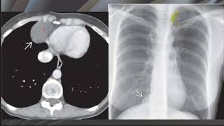 Webinar short talks : 001 Differential Diagnosis of Cardiophrenic Space Lesions