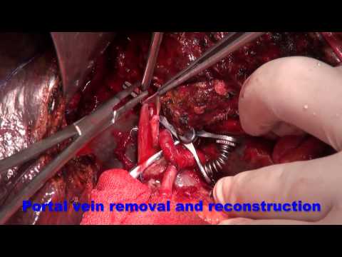 ⁬Right trisectionectomy with portal vein resection for  perihilar cholangiocarcinoma