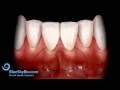 Patient Treatment Videos: Free Gingival Graft