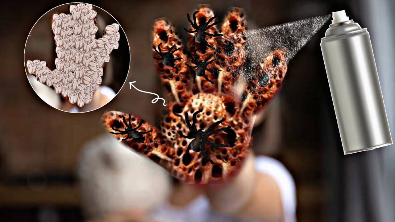 ASMR removal trypophobia & Spider infected Hand treatment animation ...