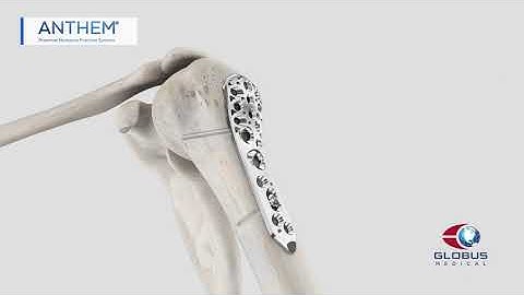 ANTHEM Proximal Humerus Surgical Animation