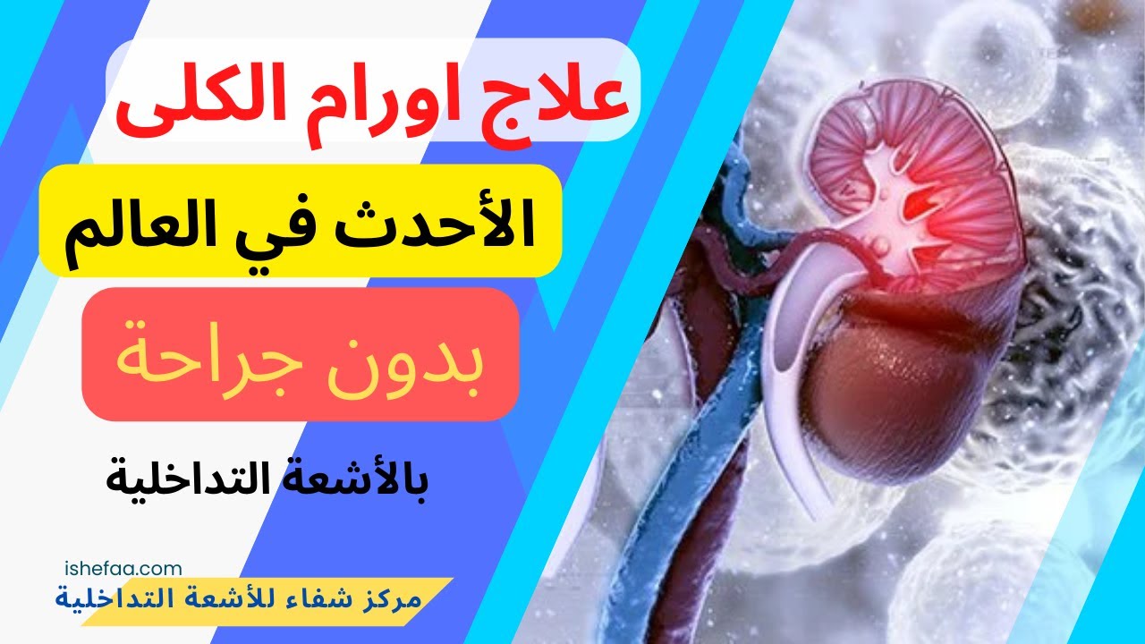 أحدث و أفضل علاج أورام الكلى واعراضها و دور الأشعة التداخلية في العلاج بدون جراحة