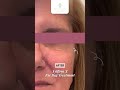 Sylfirm X Eye Bag Treatment #soleiclinic #beforeandafter