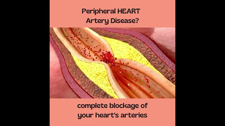 Complete Heart Blockage - Symptoms of Heart Attack - DayDayNews