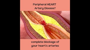 Complete Heart Blockage - Symptoms of Heart Attack
