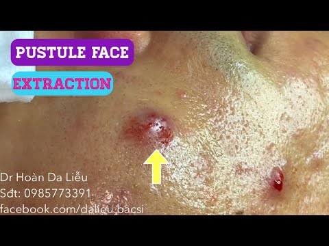 Nặn mụn nhọt má|Squeeze super big big pimples,pustule,anti acne,acne removal Dr Hoan 0985773391