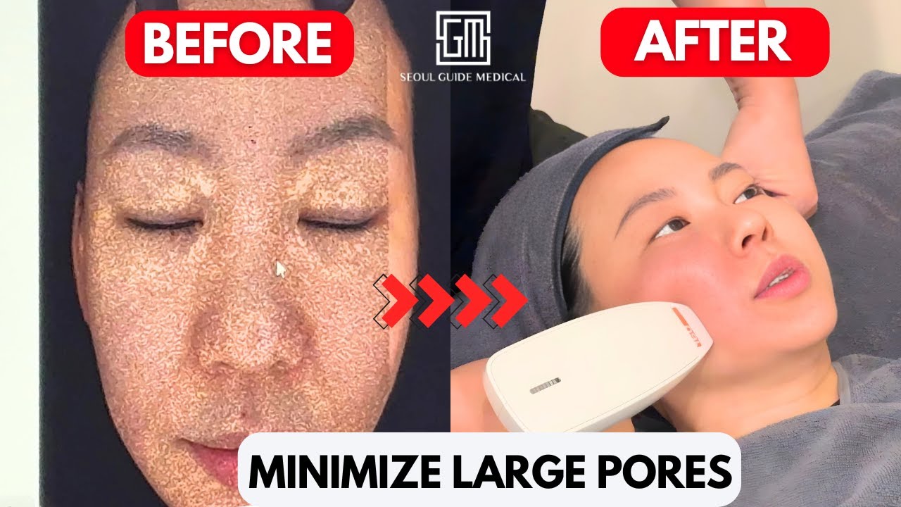 Преображение «стеклянной» кожи по-корейски ✨ | Настоящее сияние от Rydia для пор и дряблой кожи в...