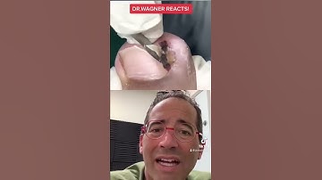 MAMMOTH INGROWN TOENAIL REMOVAL 🌋 #shorts #ingrown #ingrowntoenail