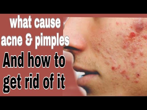 What cause acne on your Face| How to get rid of acne and pimples| 