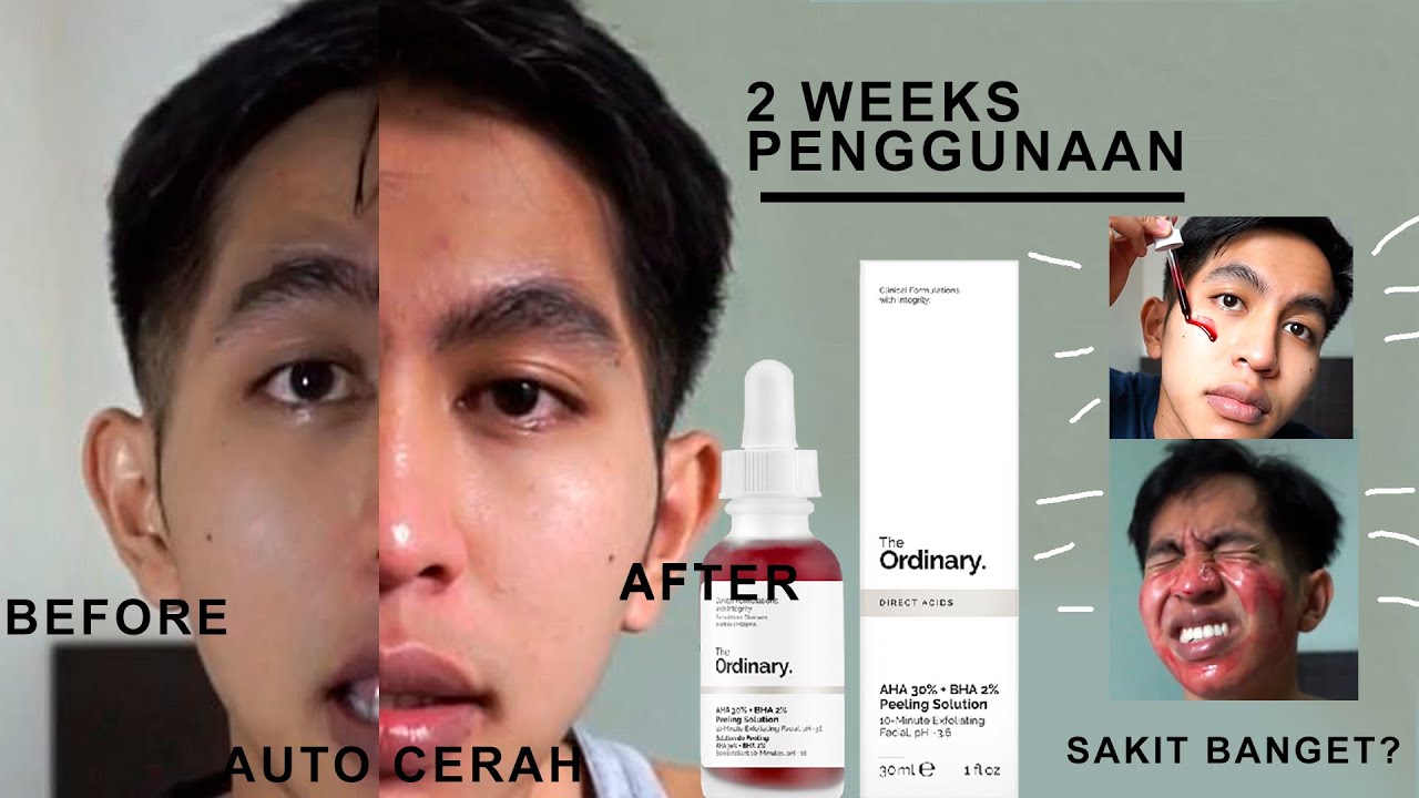 the ordinary AHA 30% + BHA 2% peeling solution review ( 2 weeks ) - YouTube