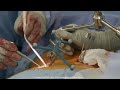 Surgical Case Trailer: Navigated MIS TLIF Procedure