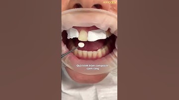 Quy trình trám răng composite răng cửa - Nha Khoa Quốc Tế KAIYEN