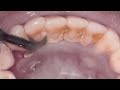 Melhores vdeos de remoo de trtaro dental do tiktok parte 1 limpeza com ultrassom