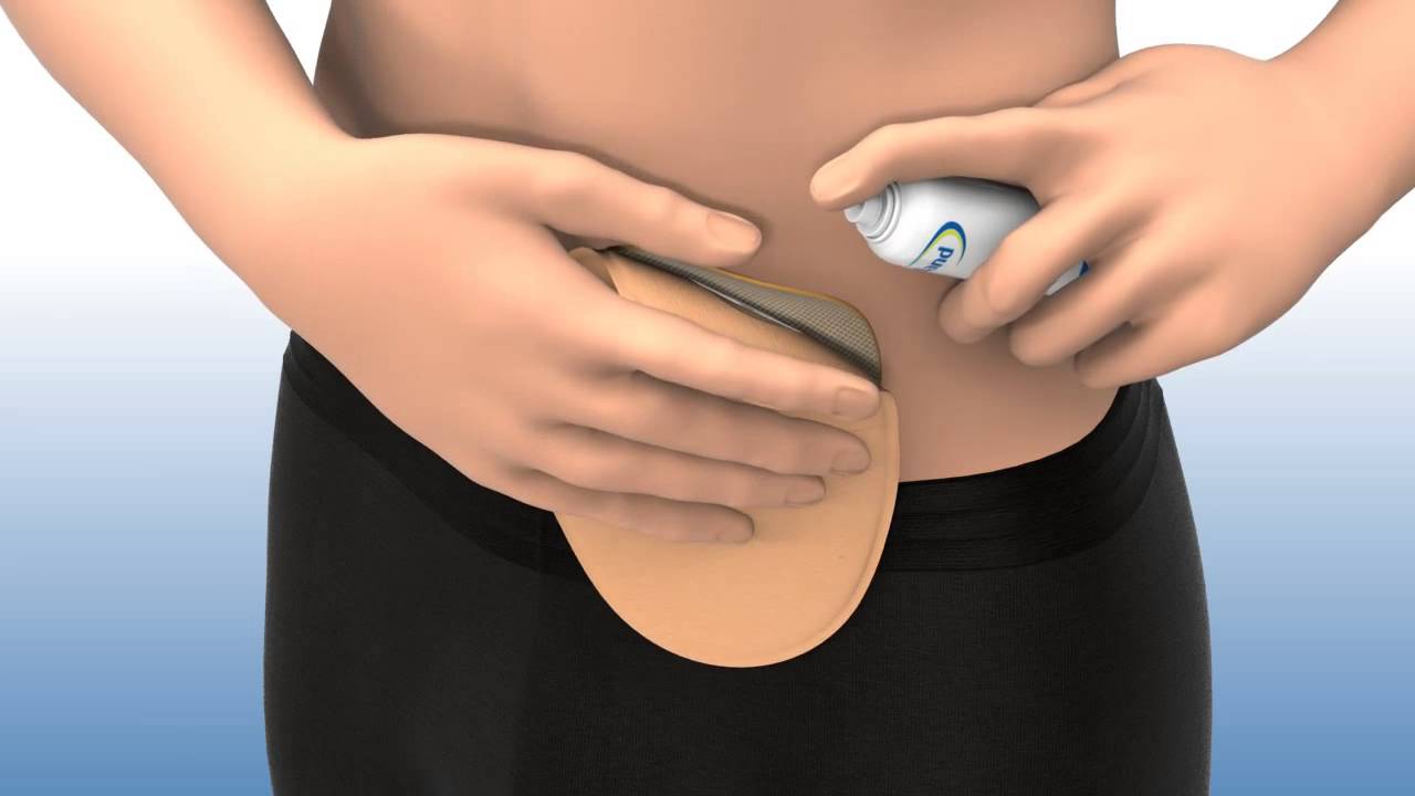 Welland Medical - easy2Peel™