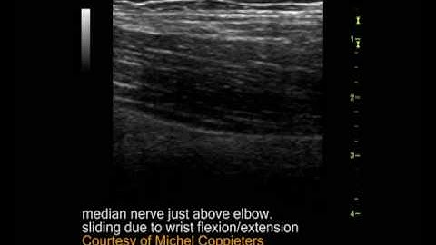 The median nerve slides and glides