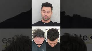 Davids 1-Year Hair Transplant Journey Life-Changing Results With Este Medical