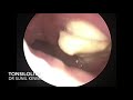 #72 Huge Tonsilolith | Removal done endoscopically