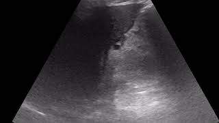 CASE 849 Missed liver cirrhosis on ultrasound fibrofatty