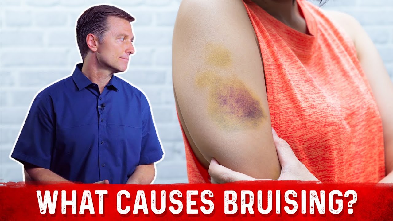 What Causes Bruising (Without Trauma) Dr. Berg YouTube