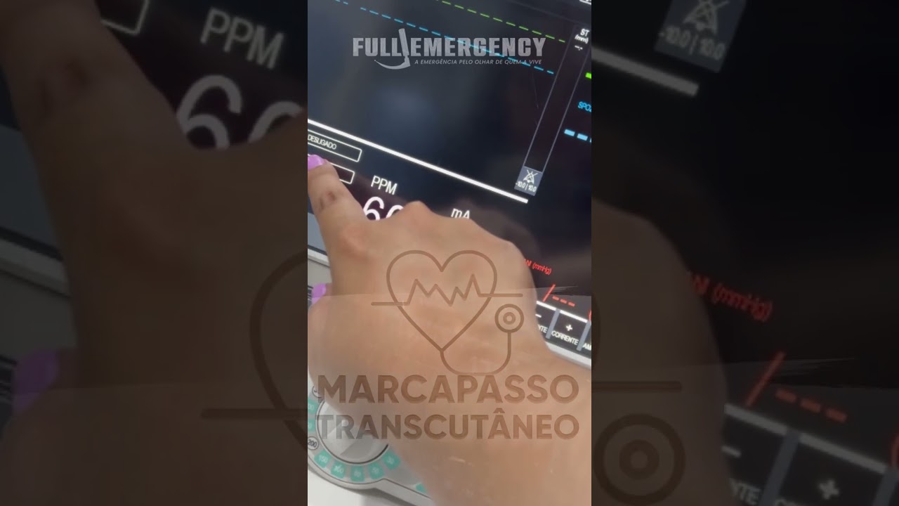 marcapasso transcutaneo full emergency