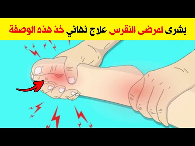 علاج مرض النقرس نهائيا