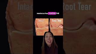Meniscus Root Tears Explained: The Small Injury That Changes Everything
