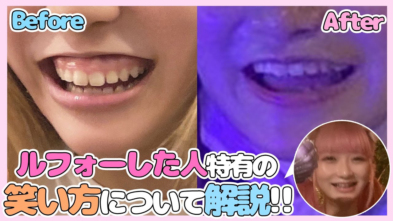 ルフォー 失敗: ルフォー 失敗 症状 , ルフォーssro の手術後、下顎がズレている – YQASLK
