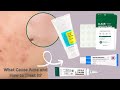 What causes Acne, and How to Treat it? A short infograph video #shorts