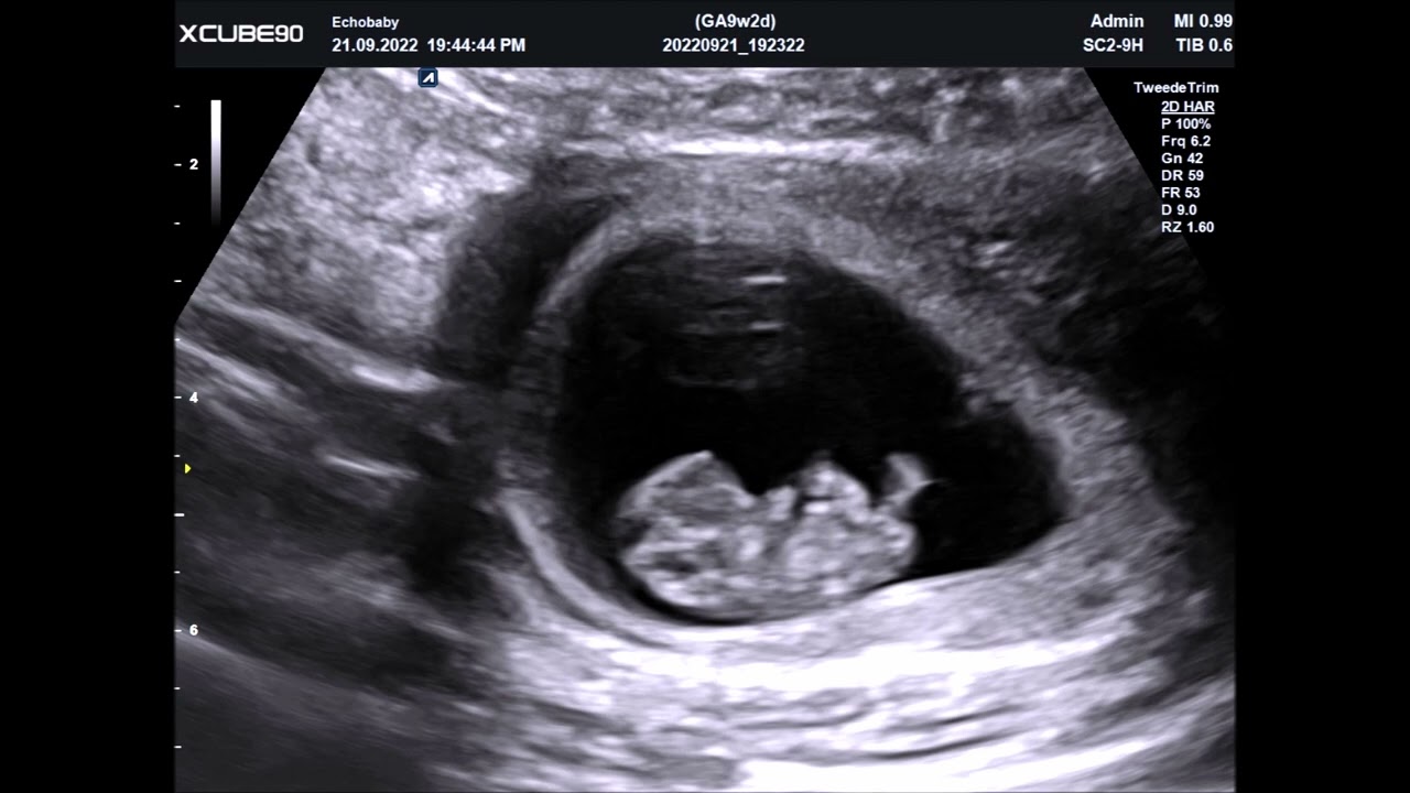 2D Baby Echo 9 Weken Zwanger Foto's en Filmpjes