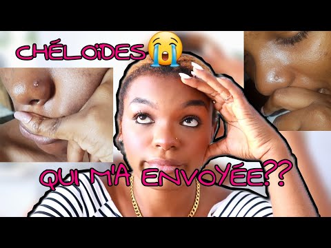 Vidéo: Qui enlève les piercings dermiques ?
