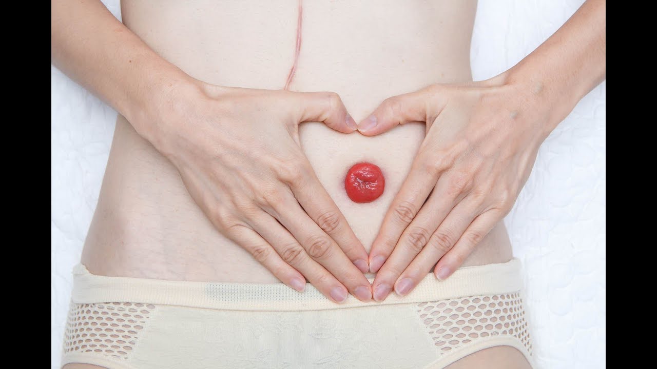 Бандаж для стомы | Бандаж послеоперационный | Абдоминальный