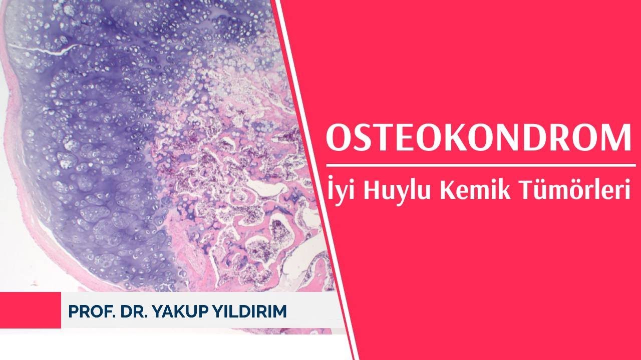 Osteokondrom - İyi Huylu Kemik Tümörleri | Prof. Dr. Yakup YILDIRIM
