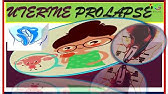 proluzi de proluse pelvie