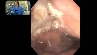 KB Live: Underwater resection of a large multilobulated ampullary tumor