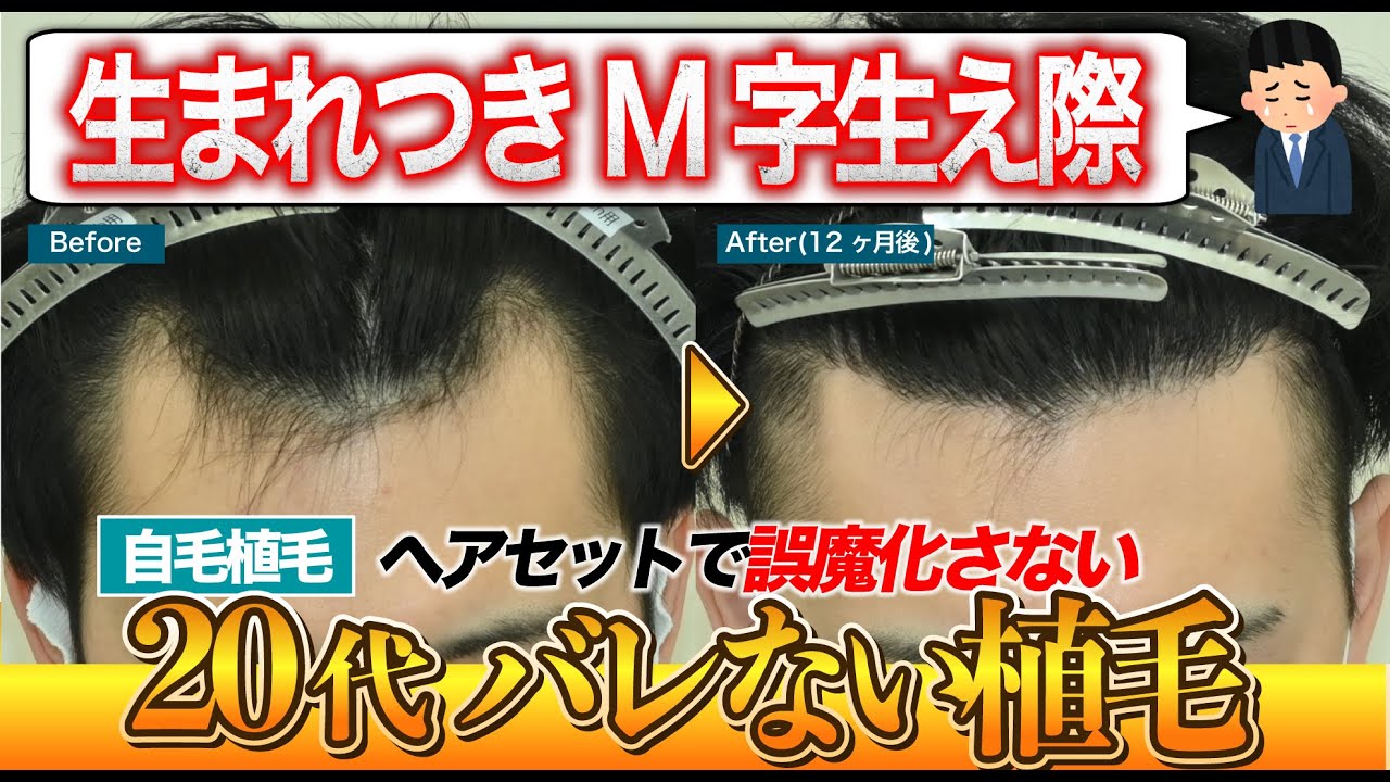 自毛植毛】10代からAGAが進行。M字生え際へ1000グラフト植毛経過【湘南