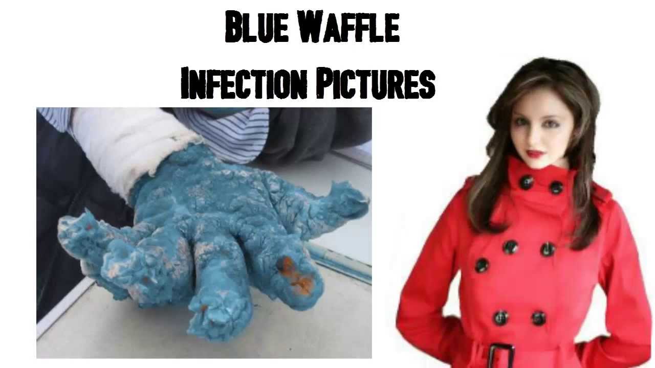 Blue Waffle, Infection (Disease Or Medical Condition), Health (Industry), B...