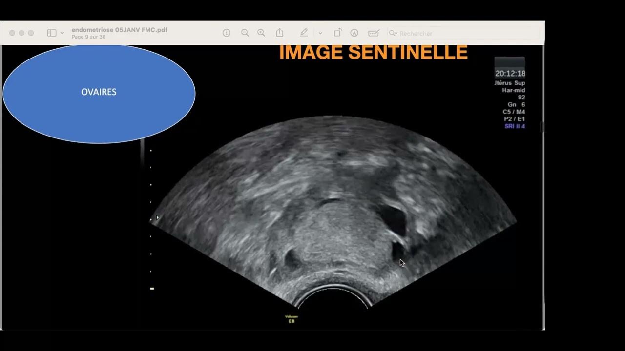 Echographie pelvienne dans l
