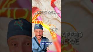 Sneeze causing disk herniation #medical #Doctor #backpain