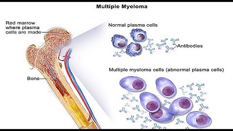 Things you must know about Multiple Myeloma [USMLE Quick Review]